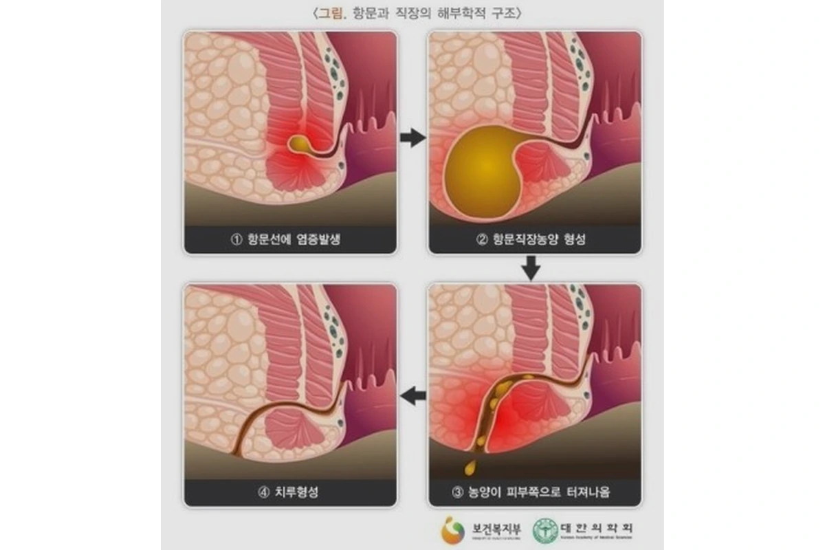 항문농양 및 치루 모식도