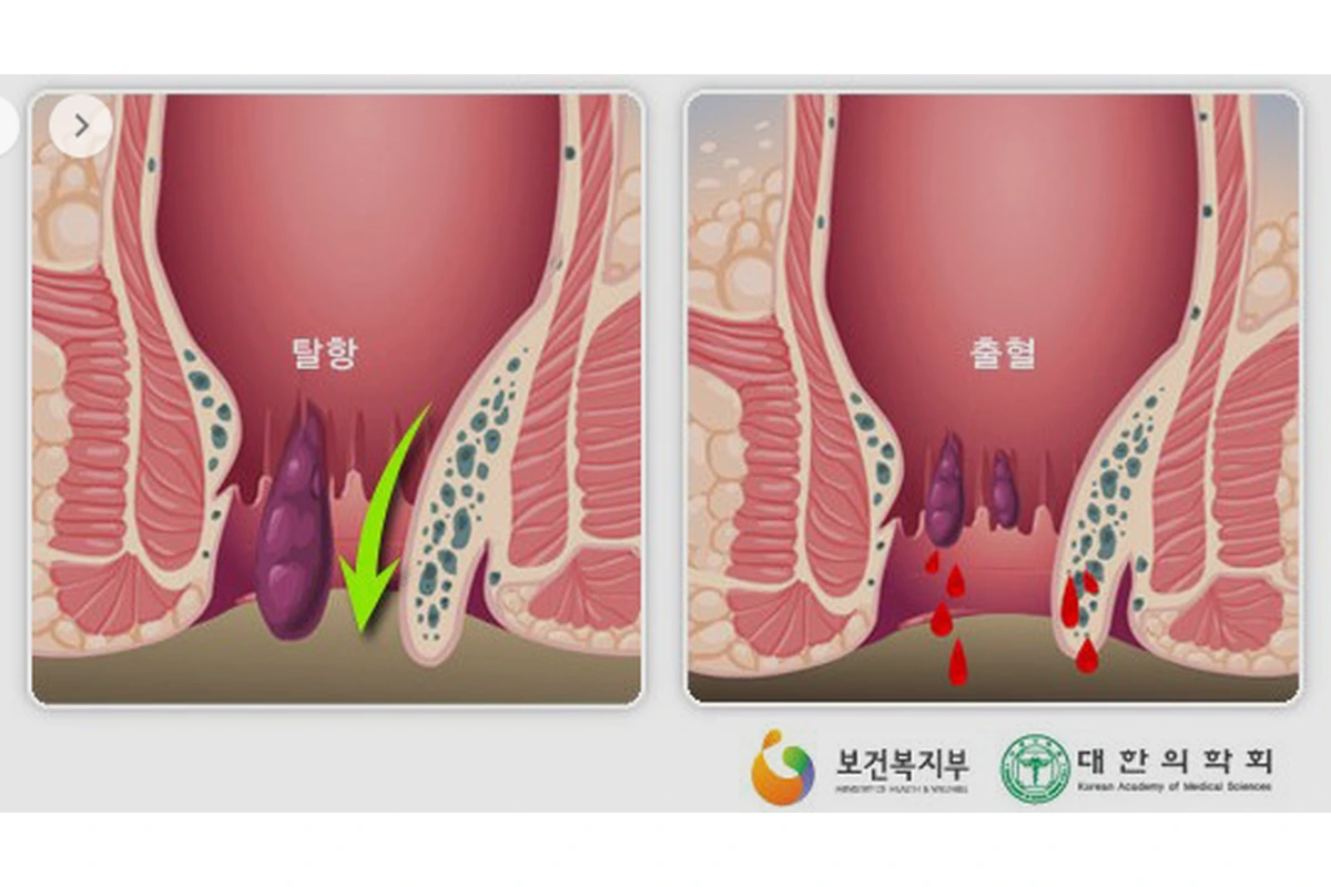 치핵모식도
