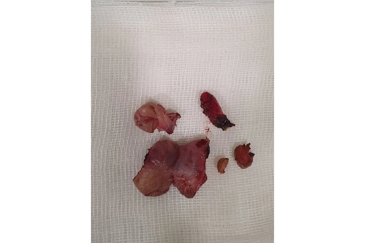 절제된 치핵 조직